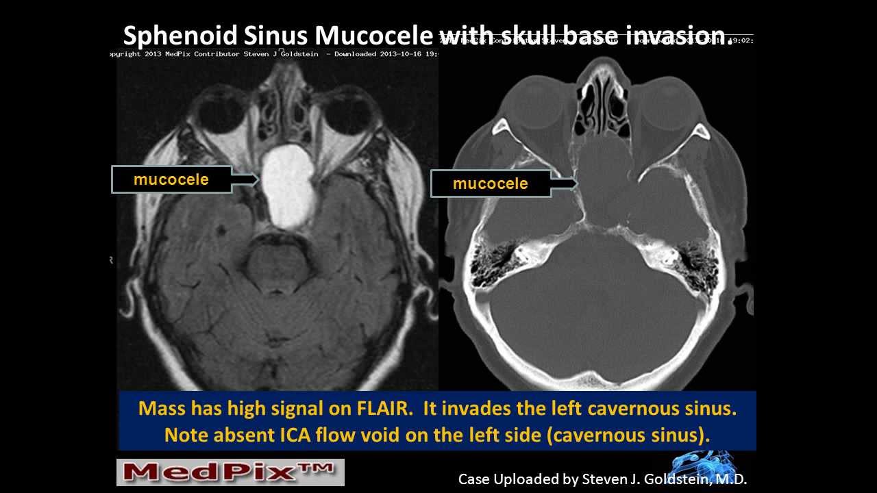 Sphenoid Sinus: Mucous Retention Cyst vs. Mucocele