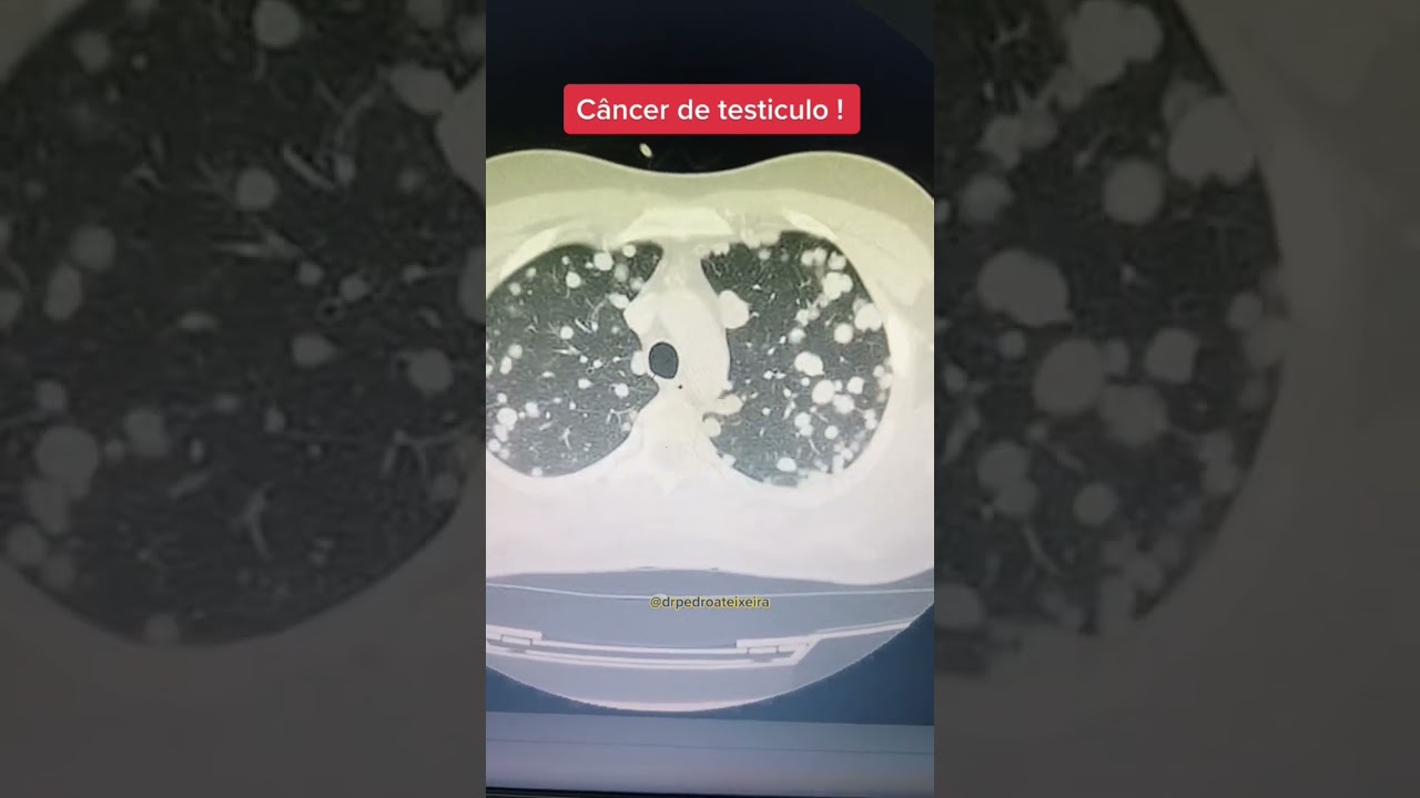 Apresentação clínica do câncer de testículo com metástases pulmonares! #saude #medicina #enfermagem