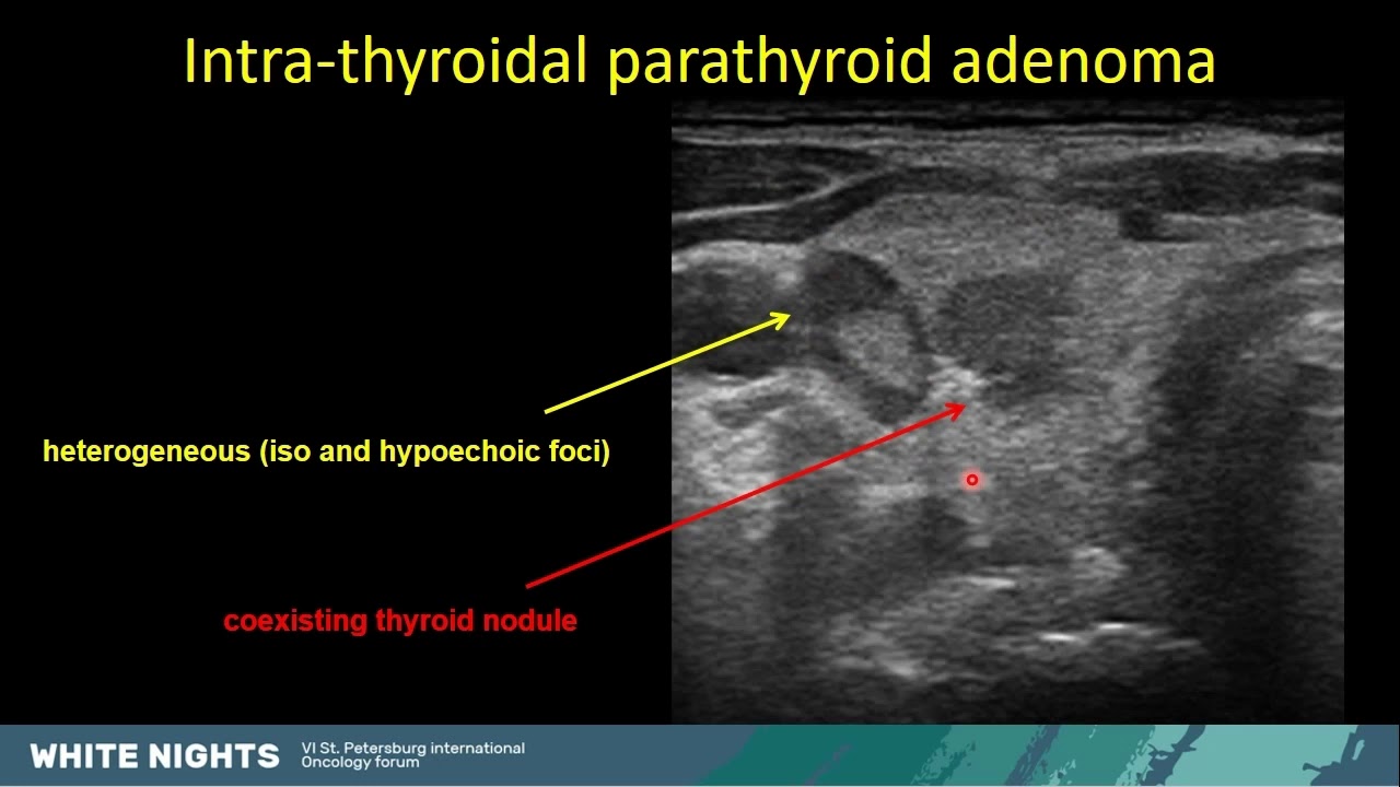 Parathyroid ultrasound when, why and how to do it? (Gerasimos Sykiotis)