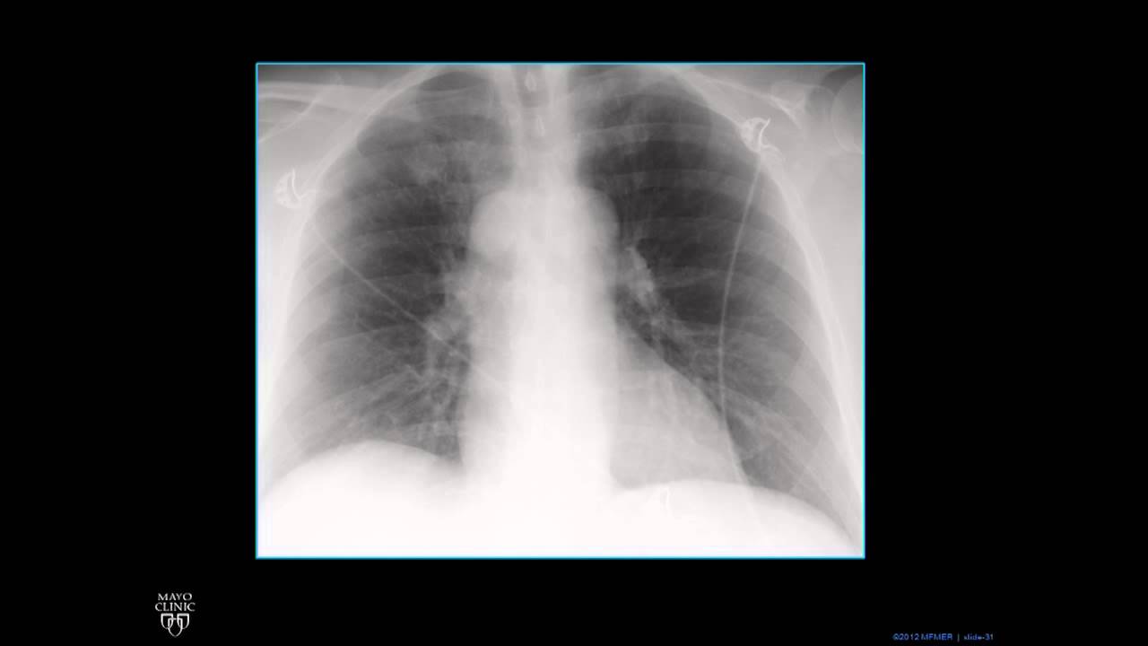 Plain Film Cardiac and Vascular Anatomy - Frontal Radiograph - Philip Araoz, M.D. - Part 2 of 10
