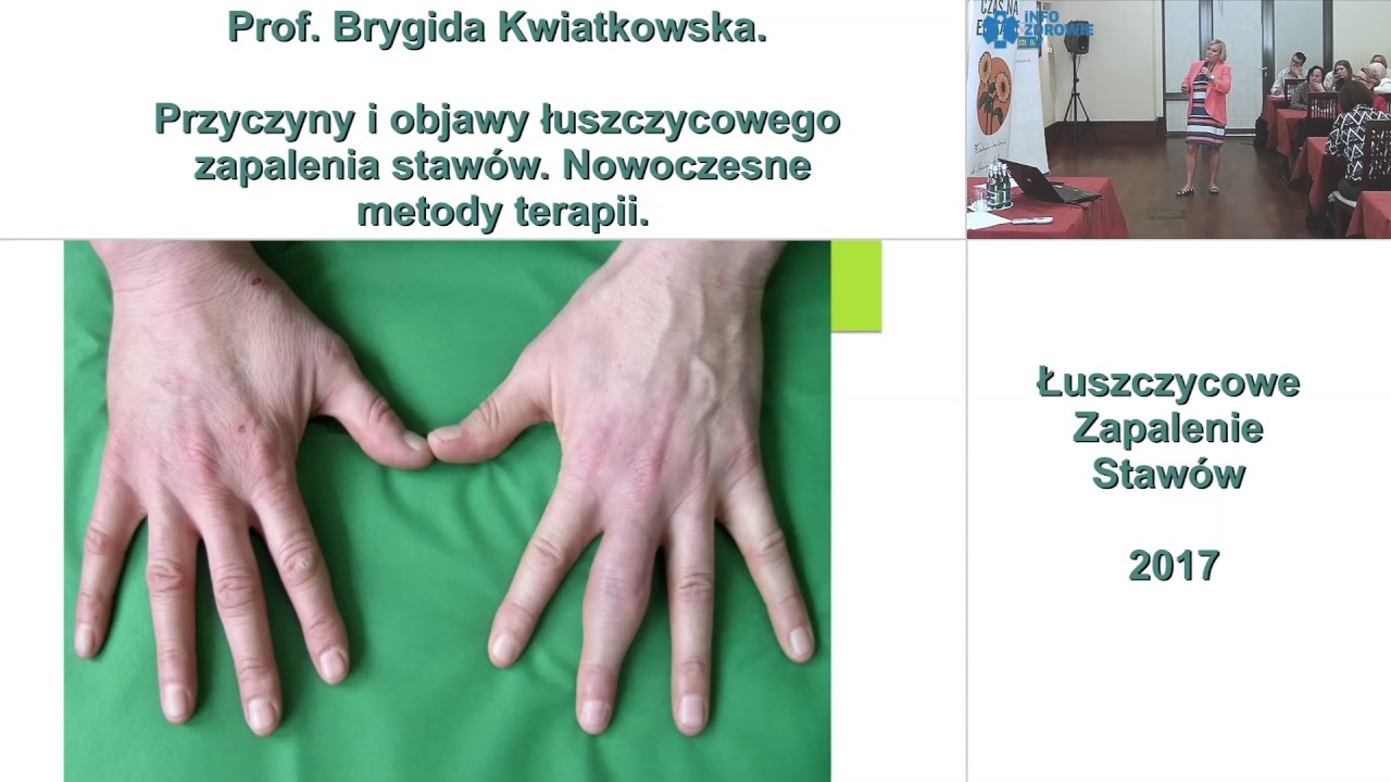 Przyczyny i objawy łuszczycowego zapalenia stawów. Nowoczesne metody terapii.