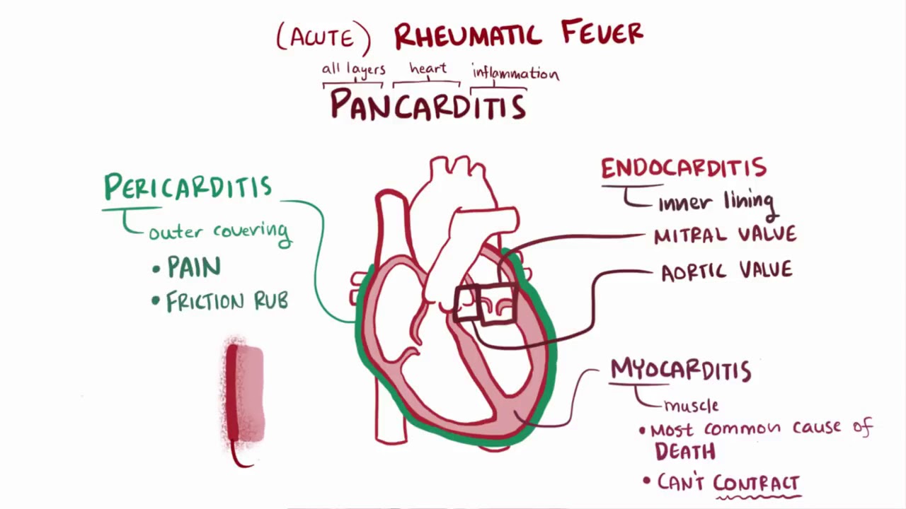 Rheumatic fever & heart disease   causes, symptoms, treatment & pathology