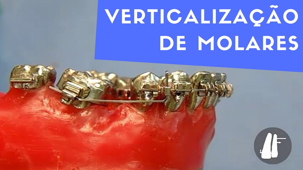 VERTICALIZAÇÃO DE MOLARES