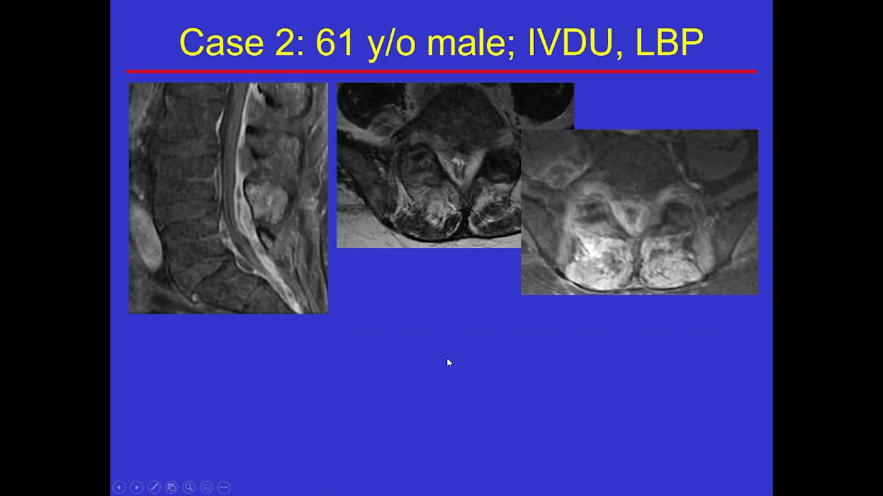 Imaging Spine infection