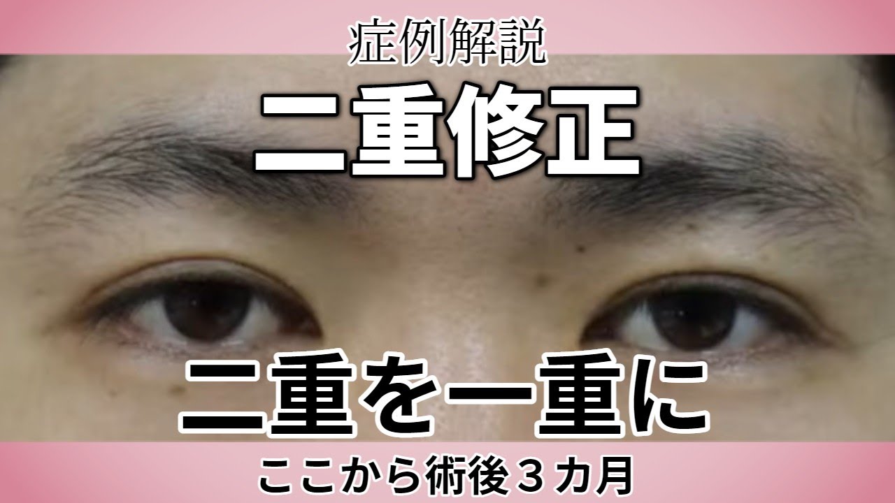 二重瞼から一重瞼への修正する整形手術／愛知県こいずみ形成クリニック
