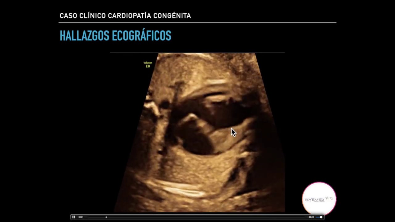 Cardiopatía congénita: Atresia tricuspidea  Caso clínico.