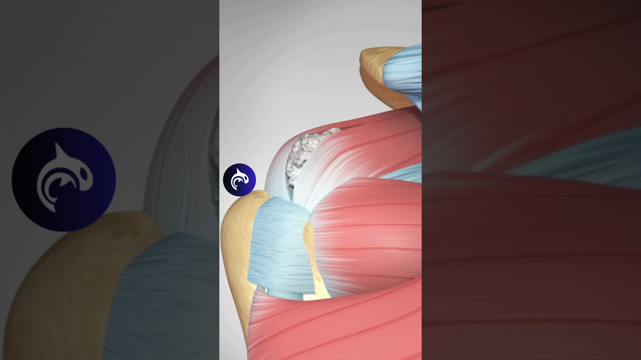 Nighttime Shoulder Pain? It Might Be Calcific Tendonitis (Calcium Deposits in your Tendon)