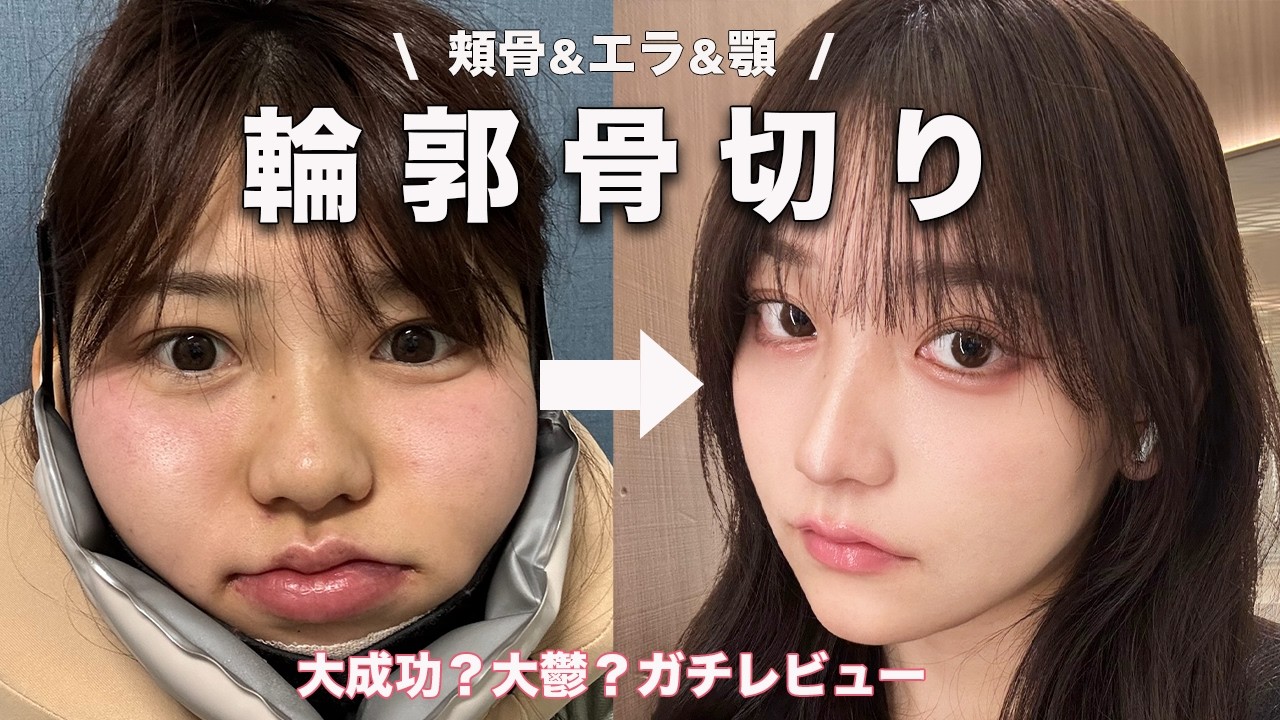 【大整形】人生を変えた「輪郭3点」の全てを語ります。