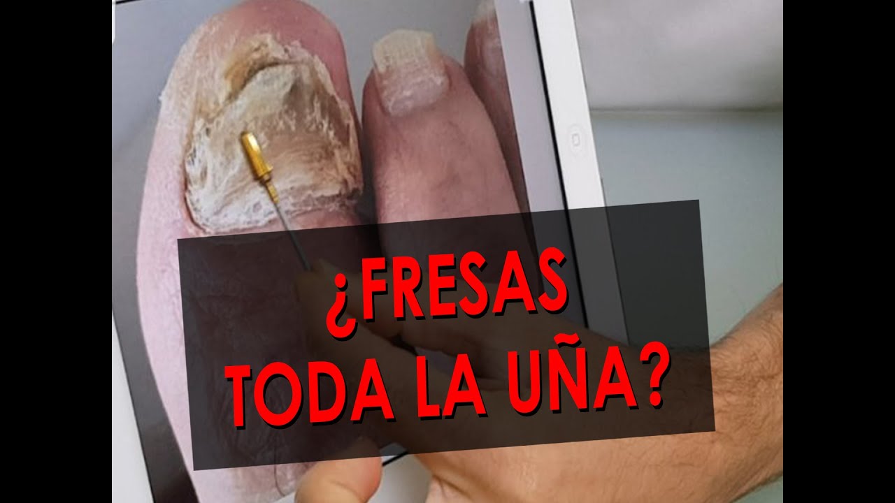 ¿Fresas toda la uña? | Podoformación.