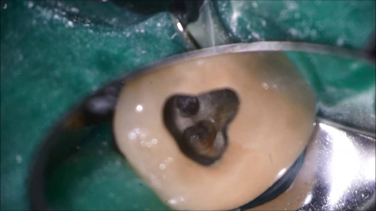 Finding Calcified Canals: Microscopic Endodontics