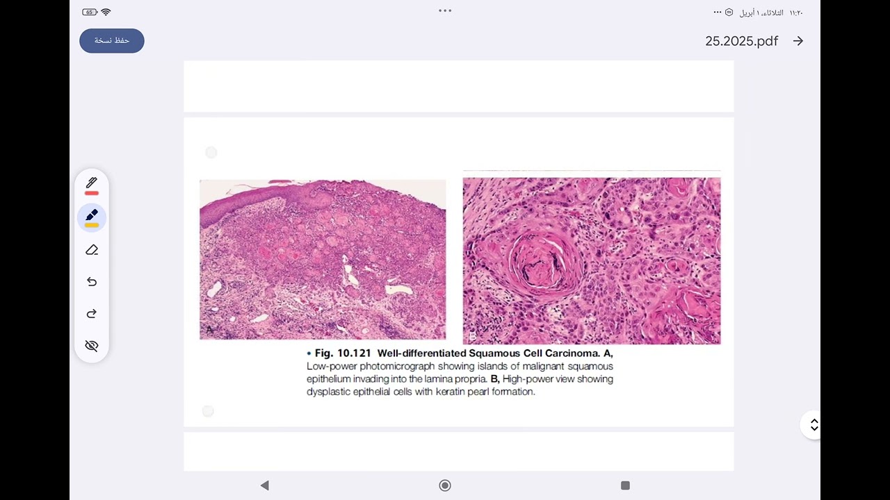 Oral pathology lec 25 epithelial pathology (squamous cell carcinoma) مرحلة رابعة طب أسنان