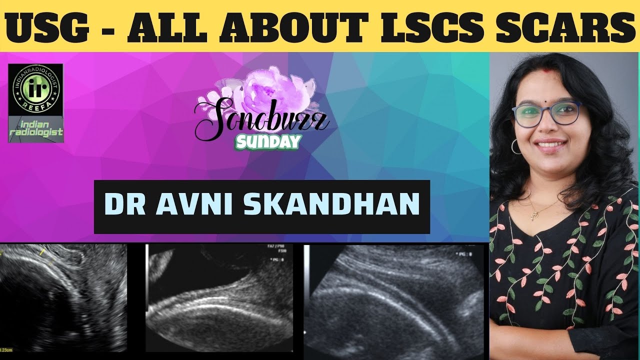 AVNI SKANDHAN || USG FOR LSCS SCAR INTEGRITY || CESAREAN SECTION || TVS ULTRASOUND || SONOBUZZ