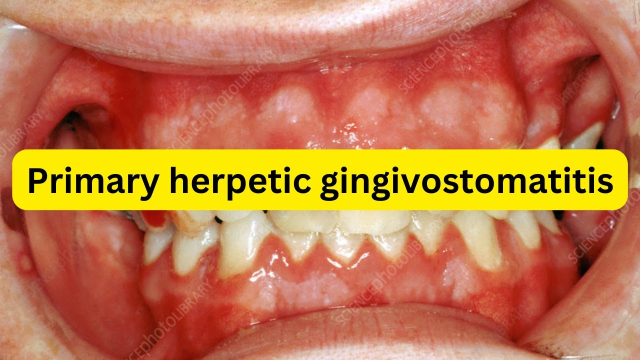 What is primary herpetic gingivostomatitis?