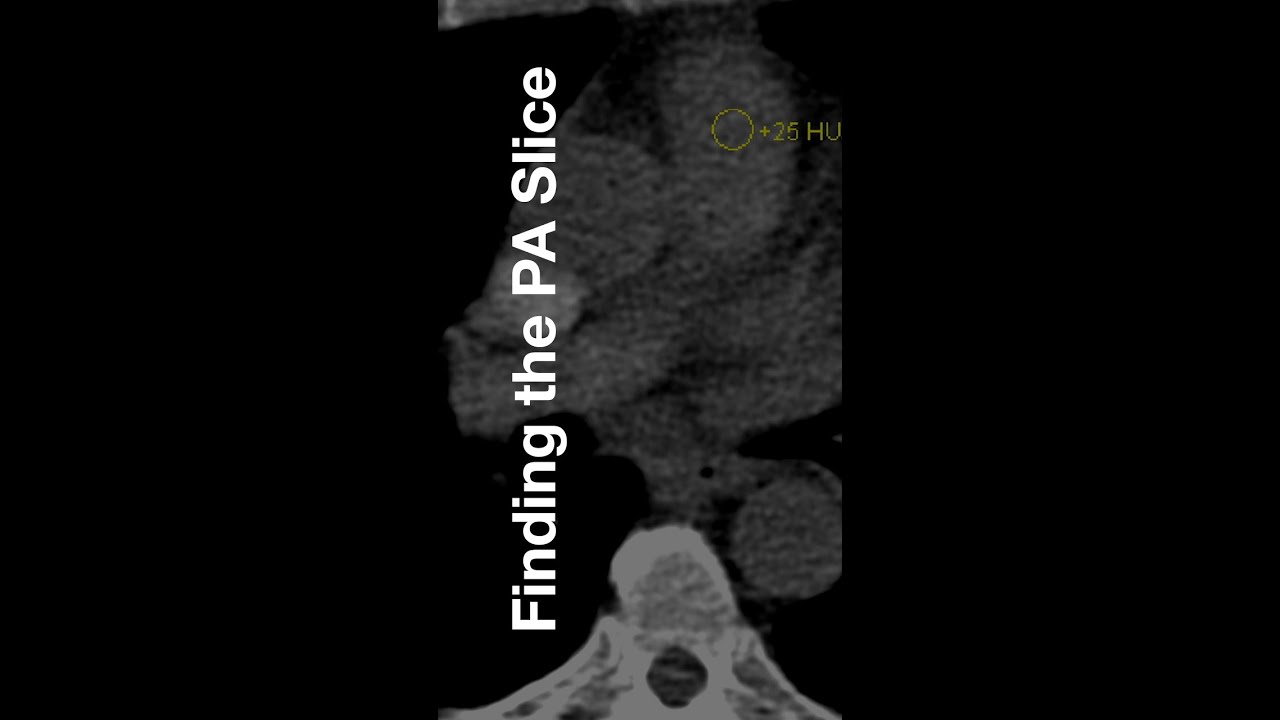 Finding the Pulmonary Artery on the Scout