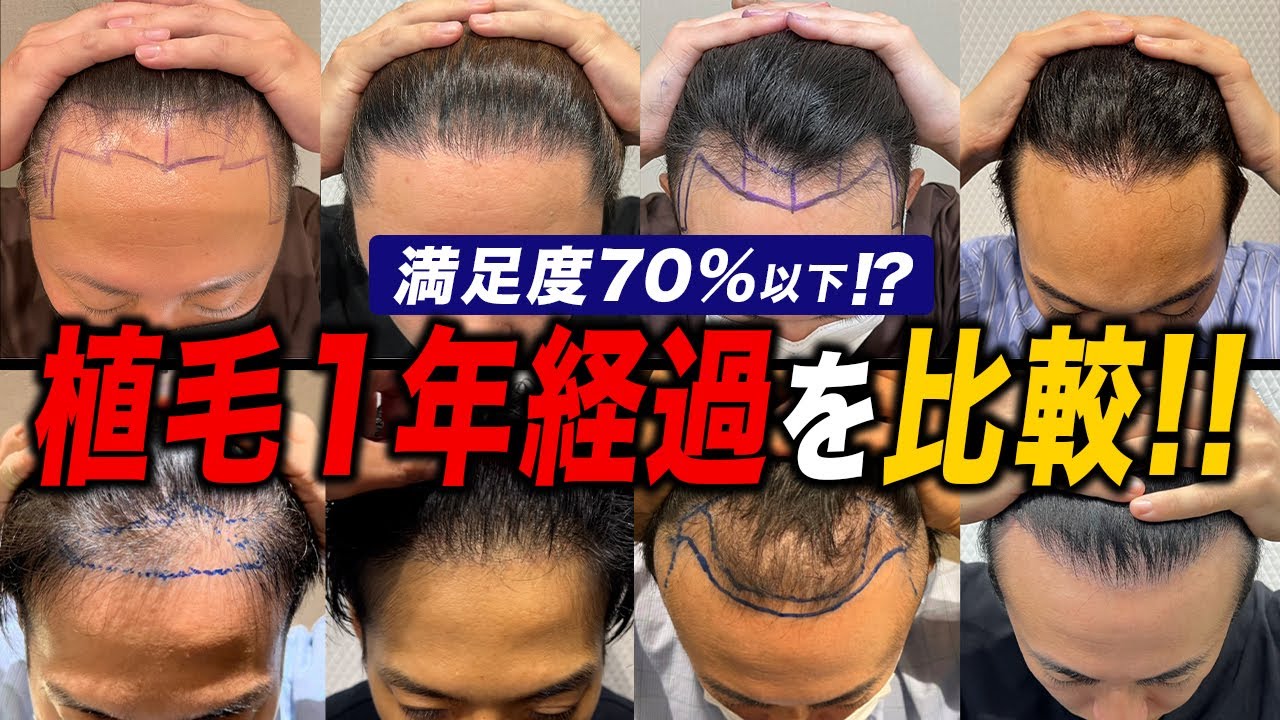 【満足度70％以下】植毛しても薄毛が満足するほど改善しなかった人を比較