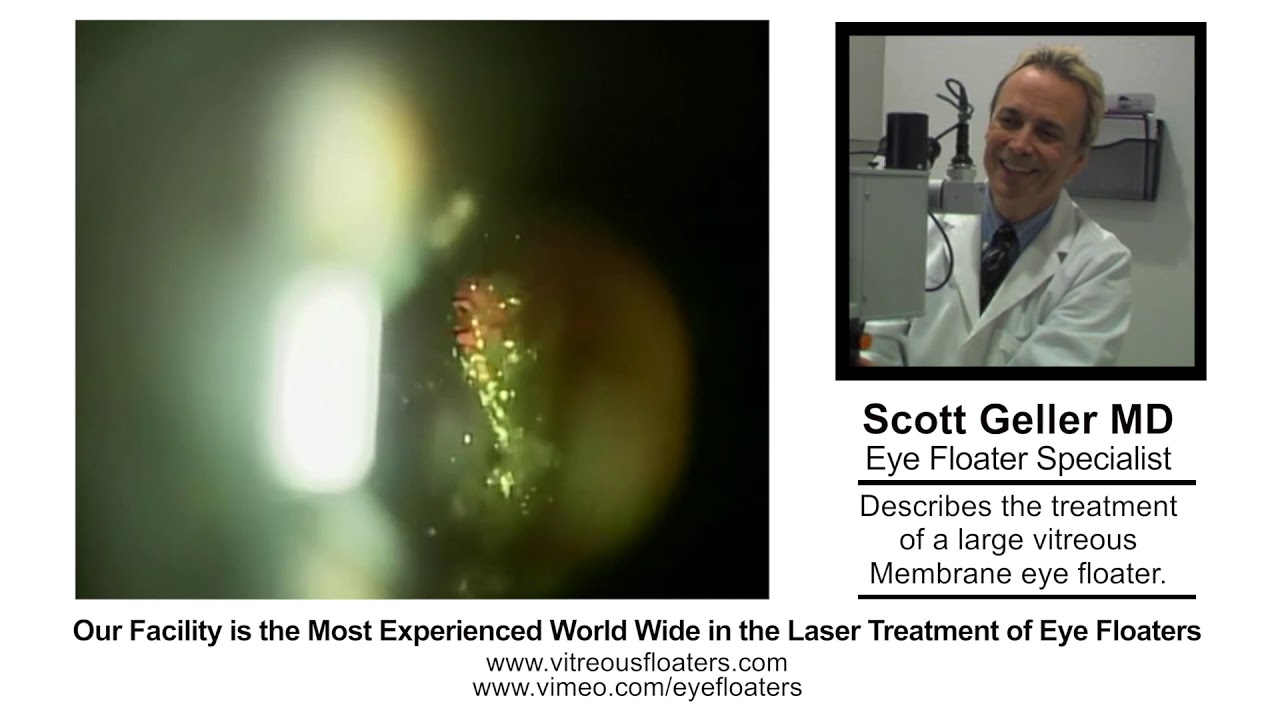 Eye Floater Laser training video for Ophthalmologists. Scott Geller MD reviews a difficult case.