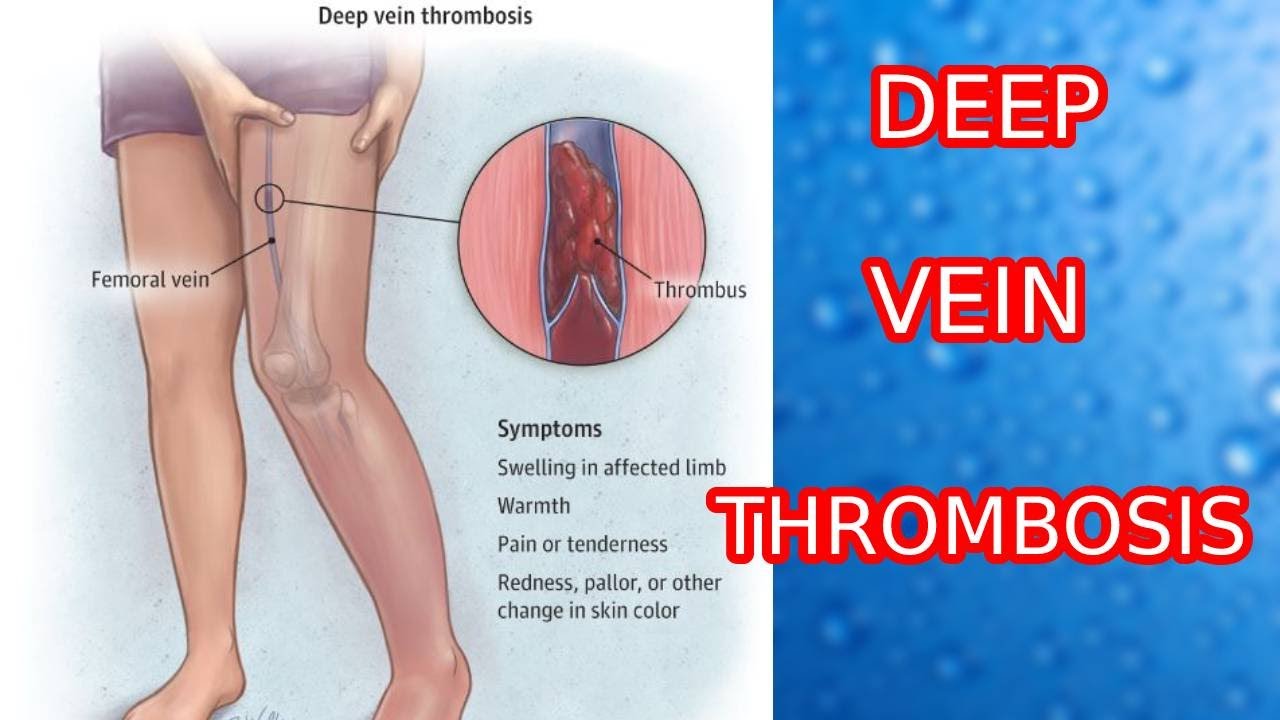 Deep Vein Thrombosis  | DVT | Symptoms and Risk Factors of Deep Vein Thrombosis