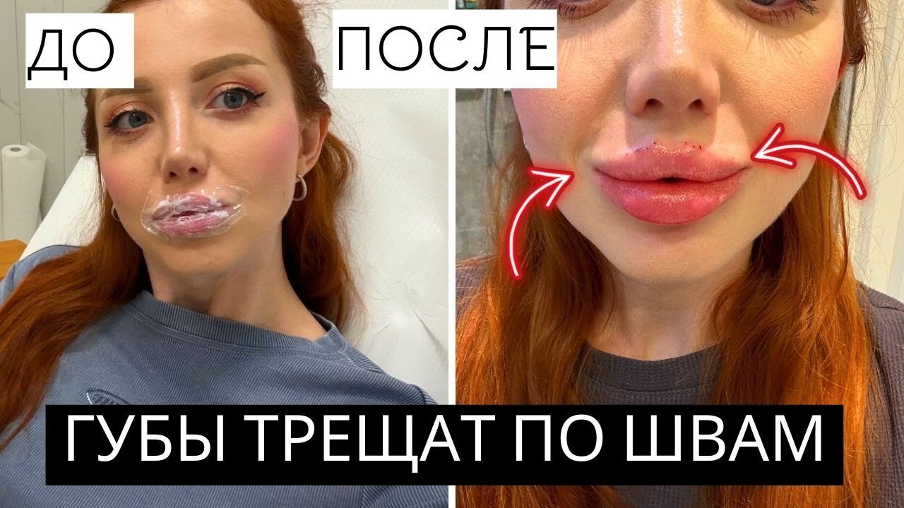 ДЕЛАЮ 4 МЛ ФИЛЛЕРА В ГУБЫ. ГУБЫ ТРЕЩАТ ПО ШВАМ! ЧТО СЛУЧИЛОСЬ С ГУБАМИ ПОСЛЕ