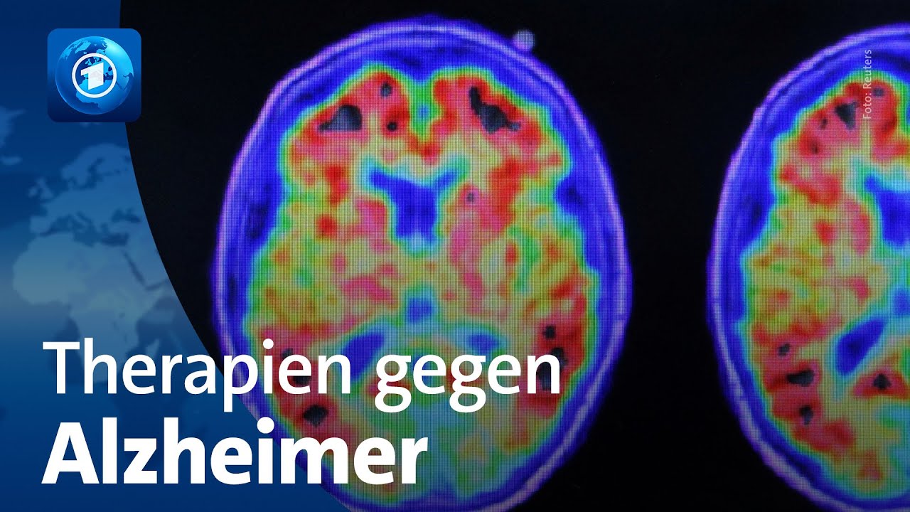 Alzheimer: Neue Therapien – aber kein Durchbruch