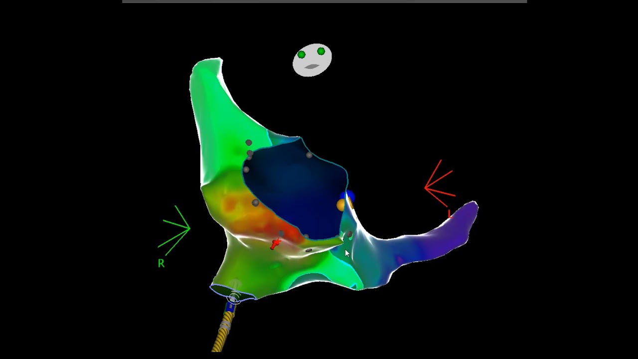 Right focal atrial tachycardia ablation