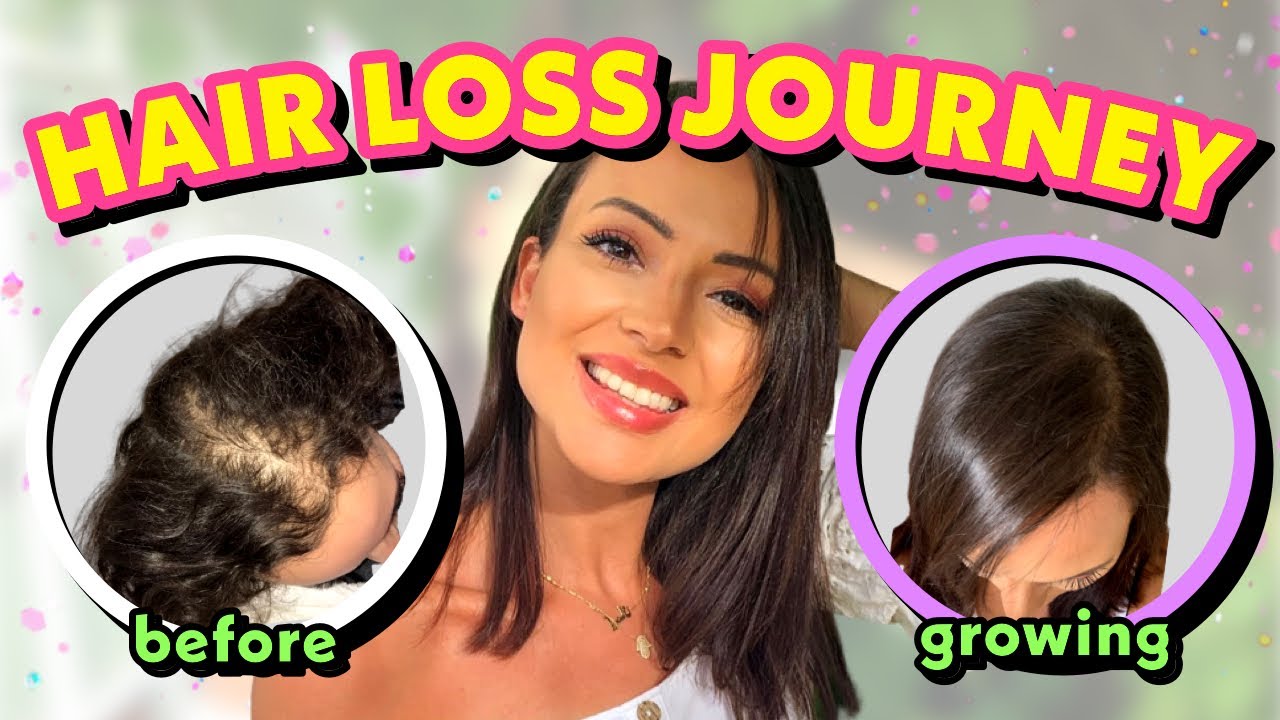 ЛЕЧЕНИЕ ВЫПАДЕНИЯ ВОЛОС У ЖЕНЩИН | МОЙ ОПЫТ БОРЬБЫ С ВЫПАДЕНИЕМ ВОЛОС + СОВЕТЫ ПО БОРЬБЕ С ВЫПАДЕ...