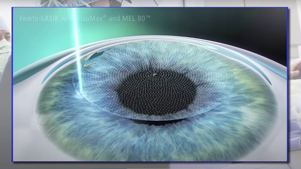 LASIK, PRK, SMILE: What's the difference?