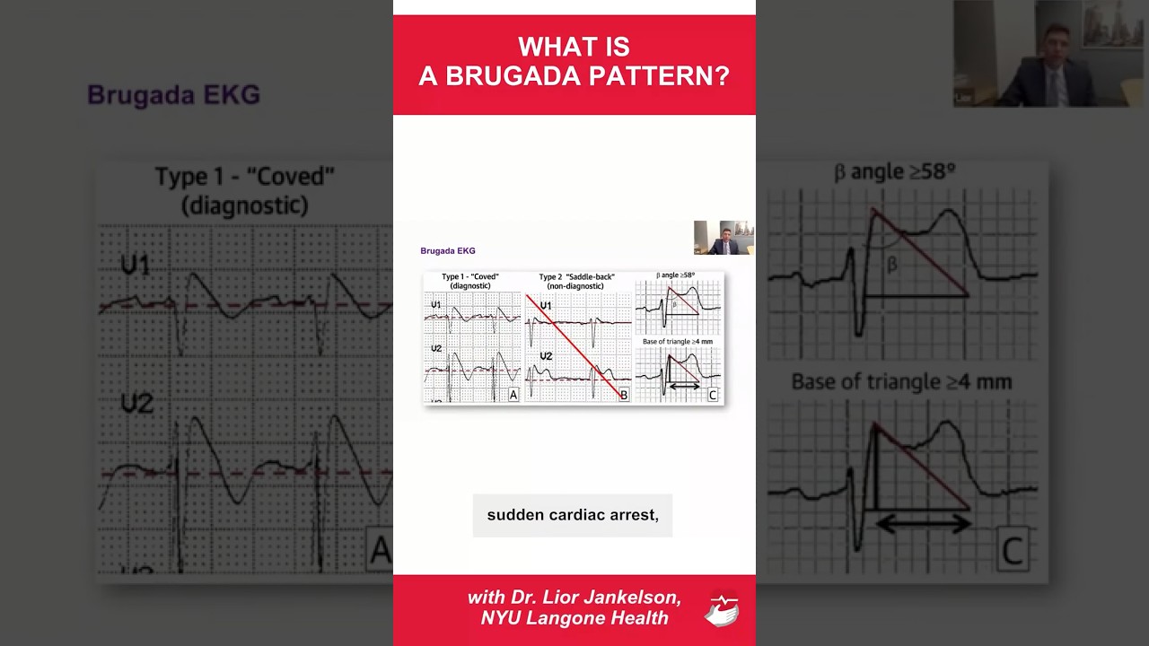 What is the Brugada pattern?