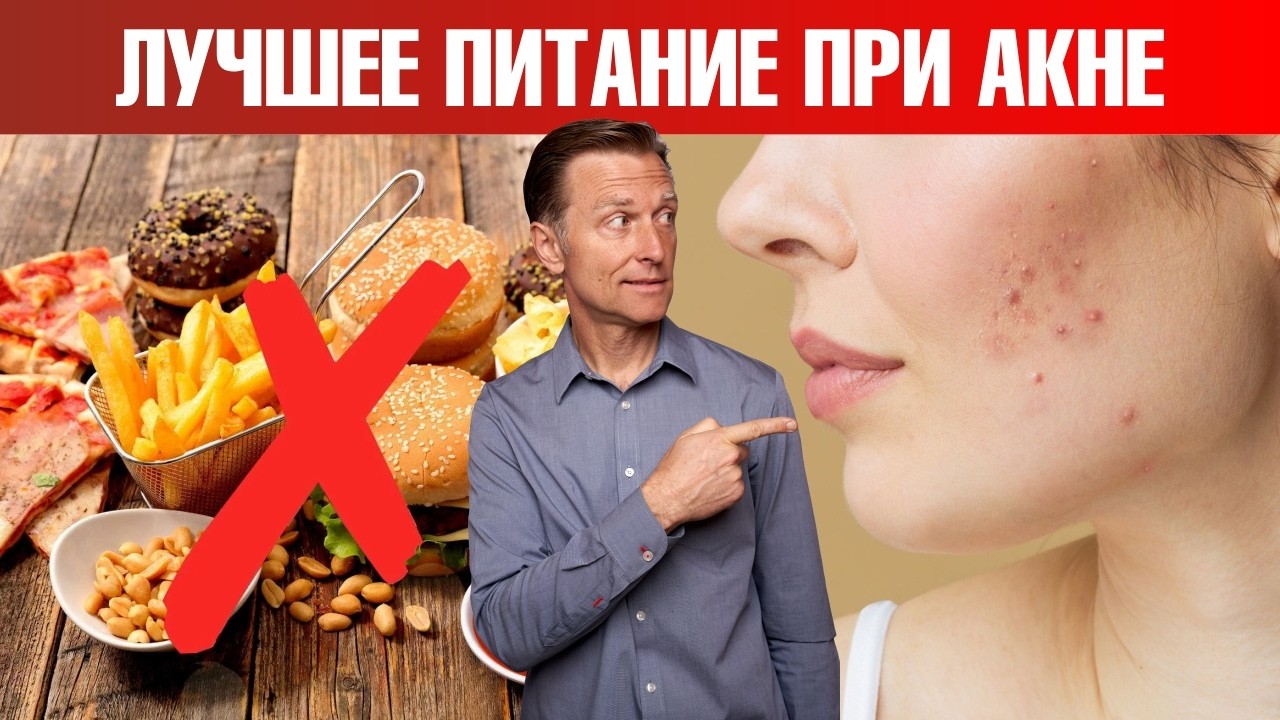 Как избавиться от акне быстрее всего?👀