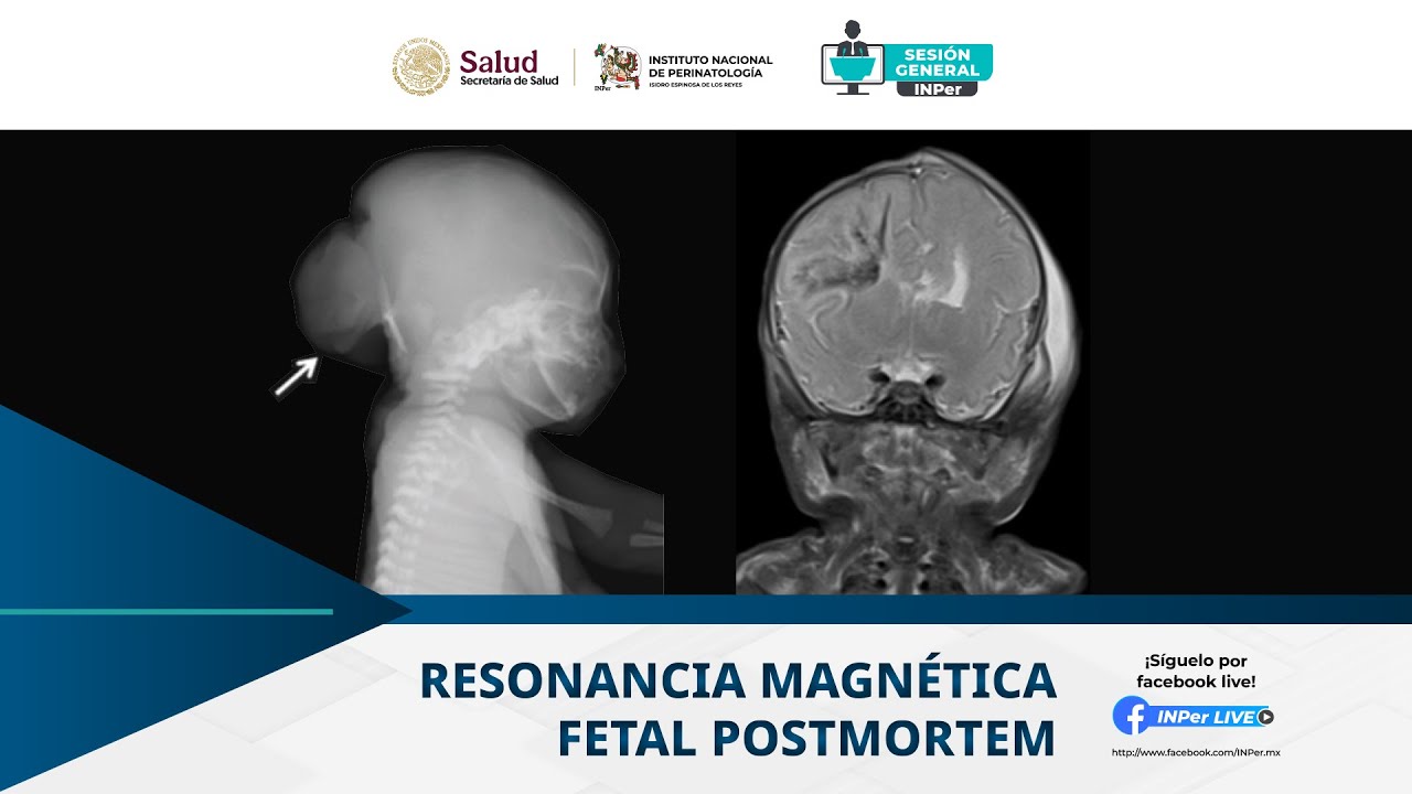 RESONANCIA MAGNÉTICA FETAL POSTMORTEM