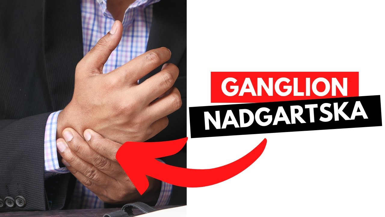 GANGLION - GANGLION NADGARSTKA - TOP 3 INFORMACJE !