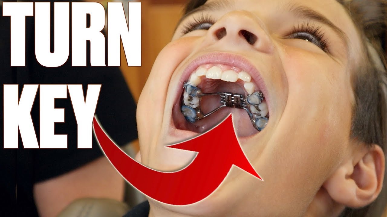 GETTING BRACES FOR THE FIRST TIME | EXPANDER WITH TURNING KEY | MAKING ROOM FOR MORE TEETH