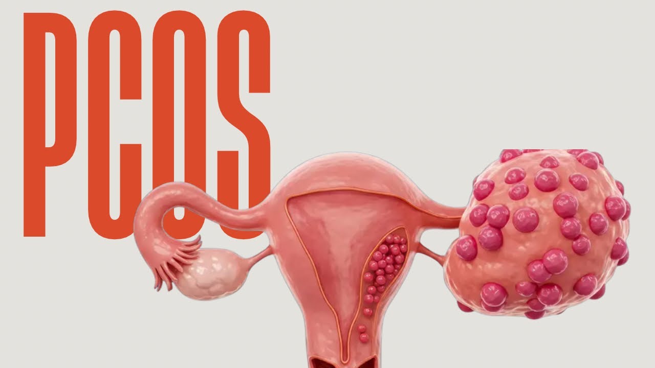 Polycystic Ovary Syndrome!