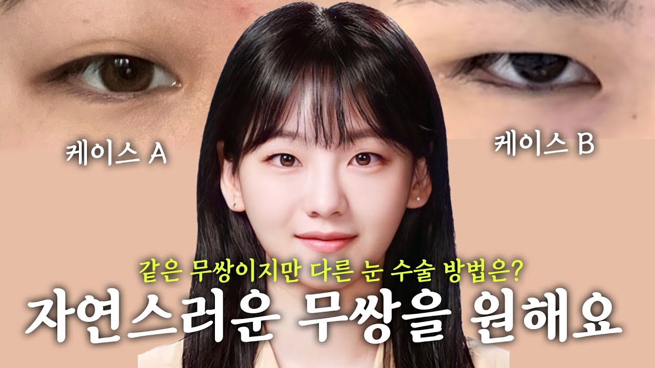 무쌍이라고 다 같은 무쌍? 나에게 어울리는 수술 방법은?