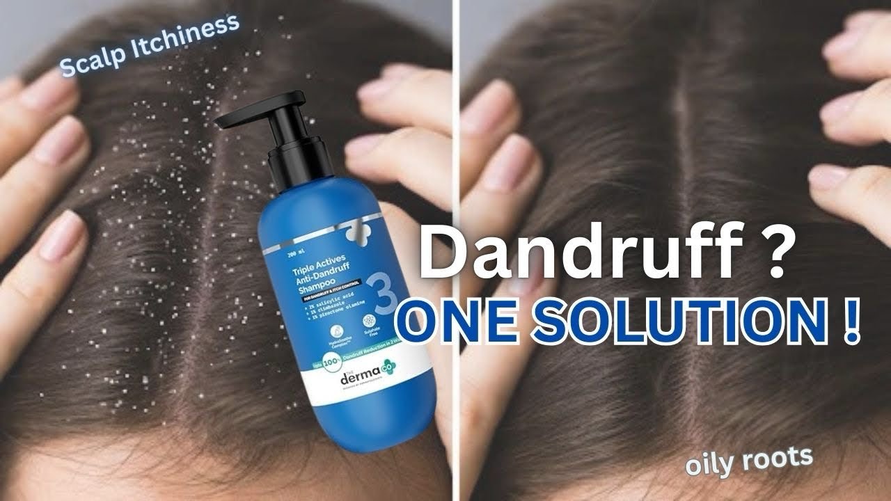 One Solution for Stubborn Dandruff | TDC Triple Active Anti-Dandruff Shampoo Review | The Derma Co 🔷