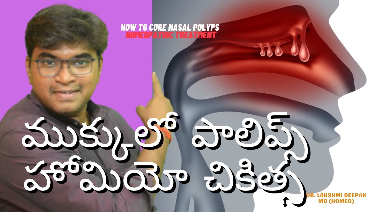 How To Cure Nasal Polyps Telugu | Homeopathy Treatment | Dr Lakshmi Deepak MD Homeo
