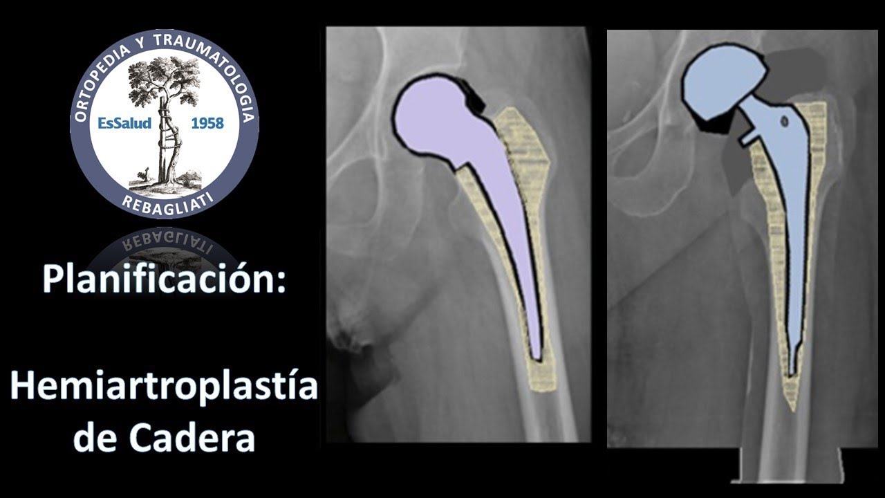 Planificación Hemiartroplastía de Cadera