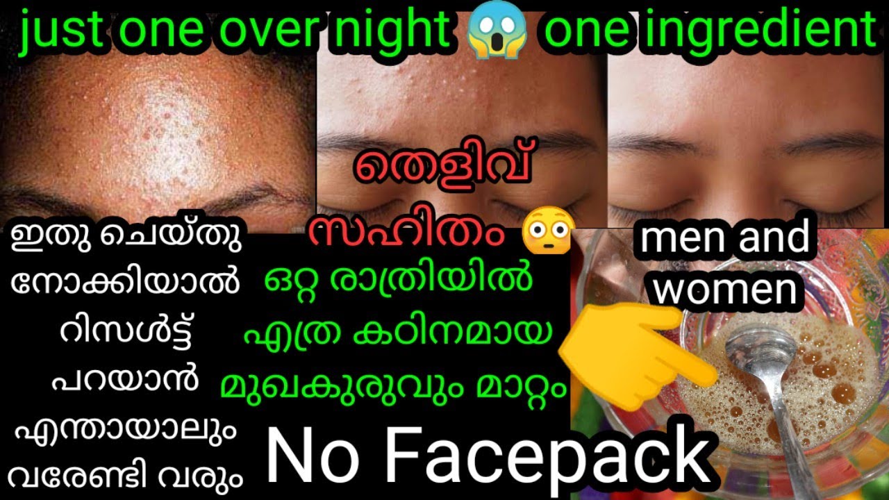 zero costOver night pimple remove|No facepack|No creams|HOMEREMEDIES ഏതു പ്രായക്കാർക്കുംഉപയോഗിക്കാം