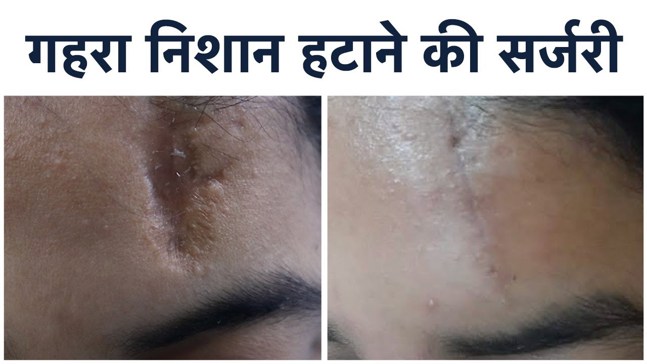 Scar Removal - निशान हटाने की सर्जरी - Discussing a patient case, Technique & Post Operative Care!