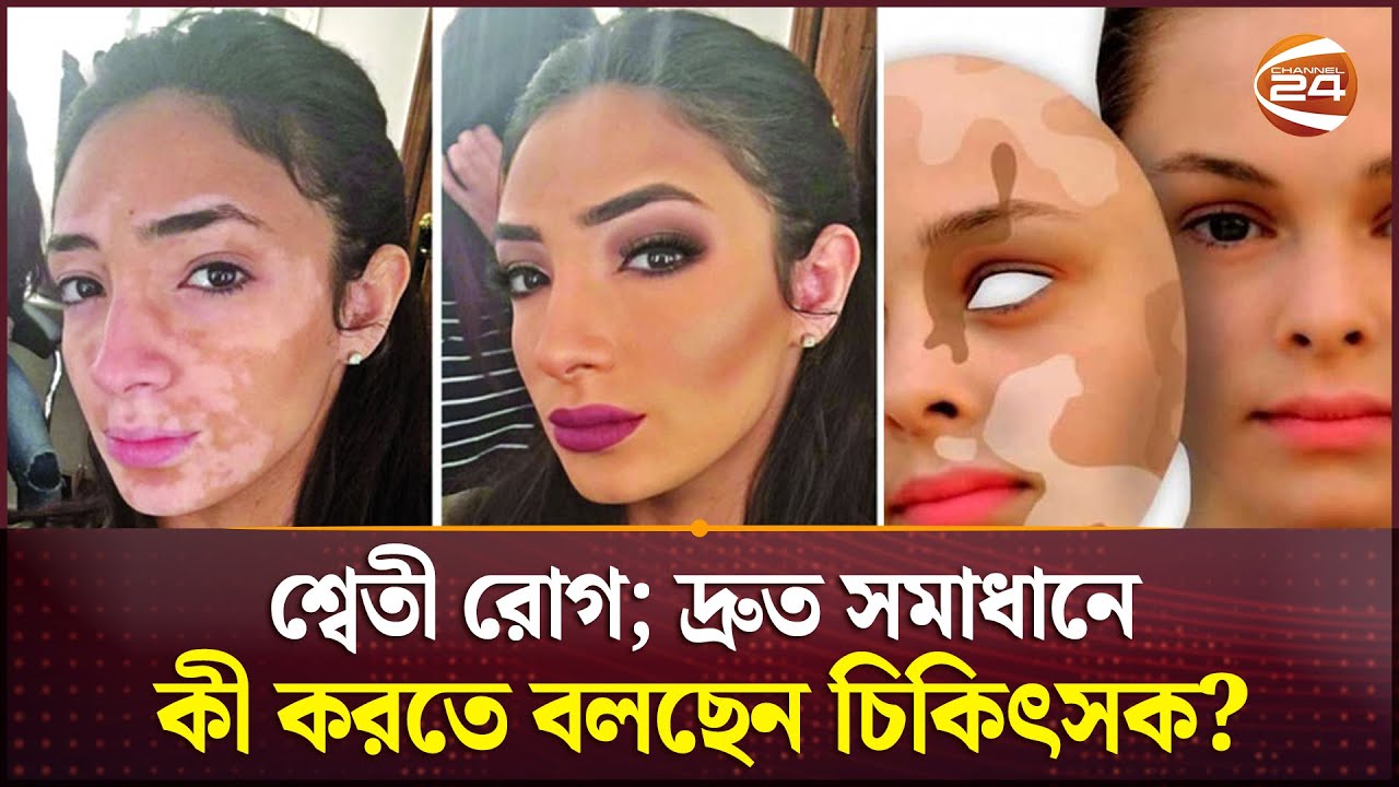শ্বেতী রোগ; দ্রুত সমাধানে কী করতে বলছেন চিকিৎসক? | Dermatology | Skin care | Skin Diseases
