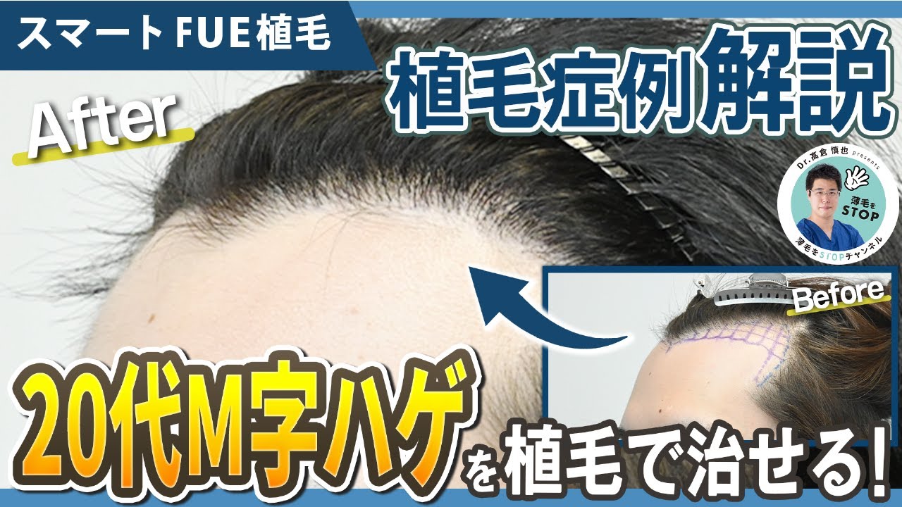 【植毛症例】M字のお悩み改善！