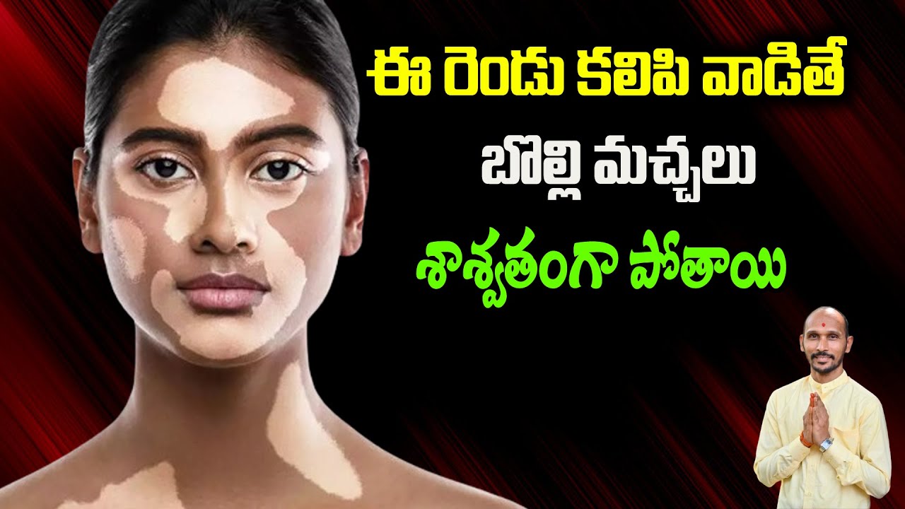 ఈ రెండు కలిపి వాడితే బొల్లి మచ్చలు శాశ్వతంగా పోతాయి | Dr.Madhu Babu Health Trends
