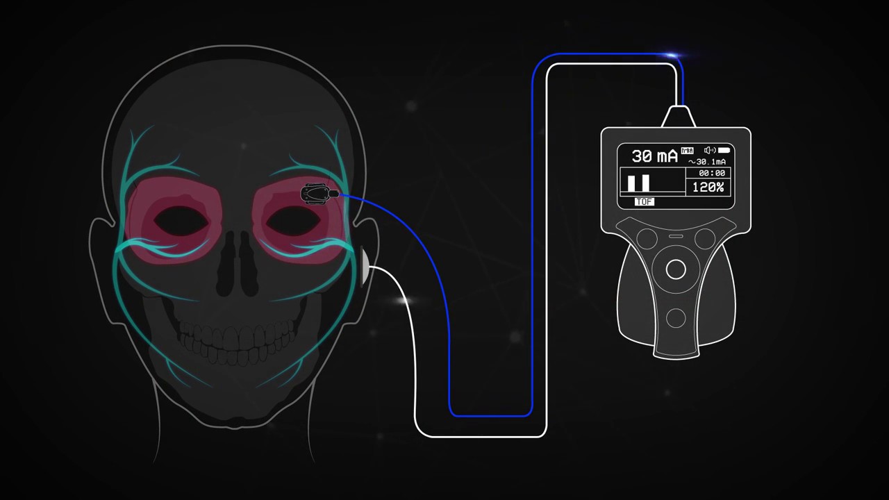 Train of Four Monitoring using the Facial Nerves
