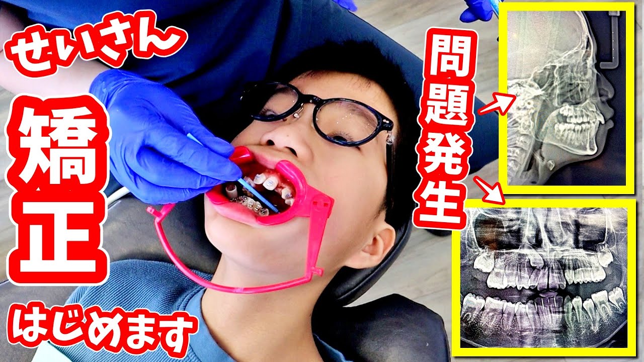 せいさん 矯正をはじめる😁 が、レントゲンを撮ったら問題が・・・どうなる❓