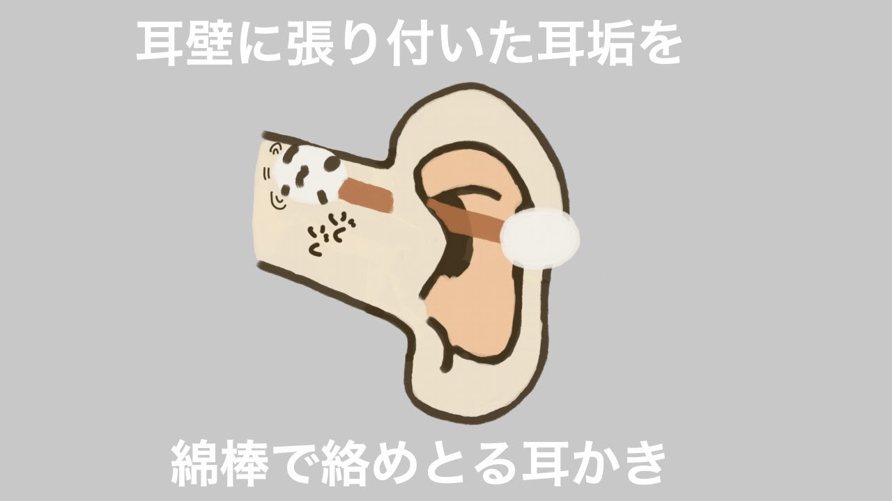 【ASMR】耳壁に張り付いた耳垢を綿棒で絡めとる耳かき Ear Cleaning 【No Talking】