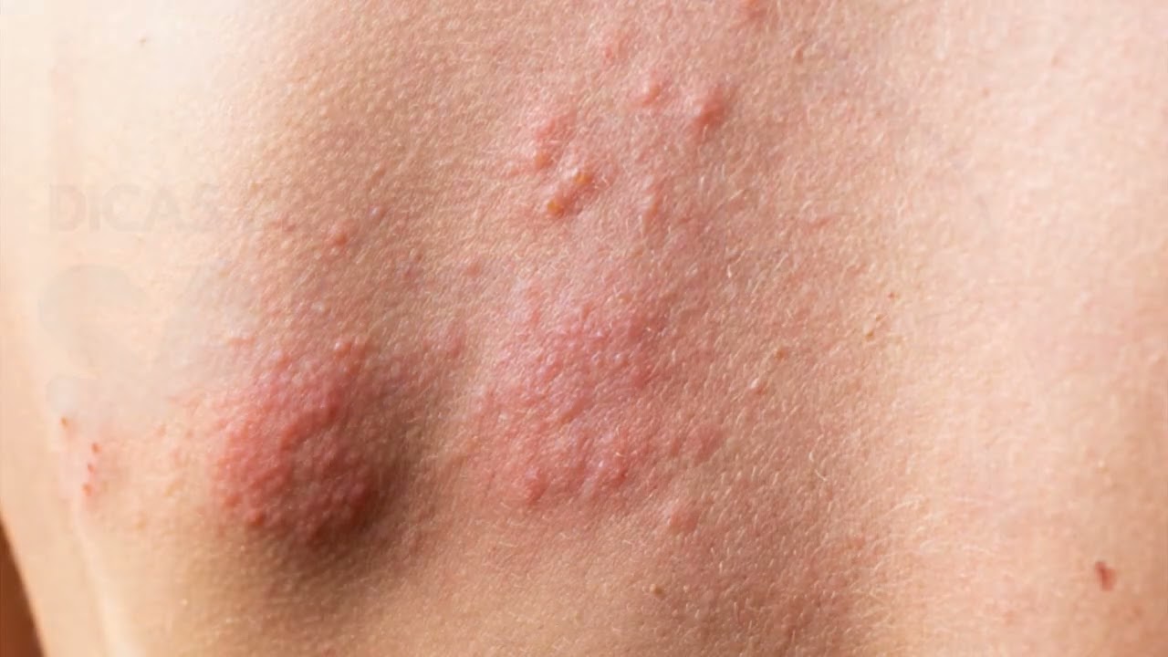 DOENÇA DERMATOLOGICA CRÔNICA