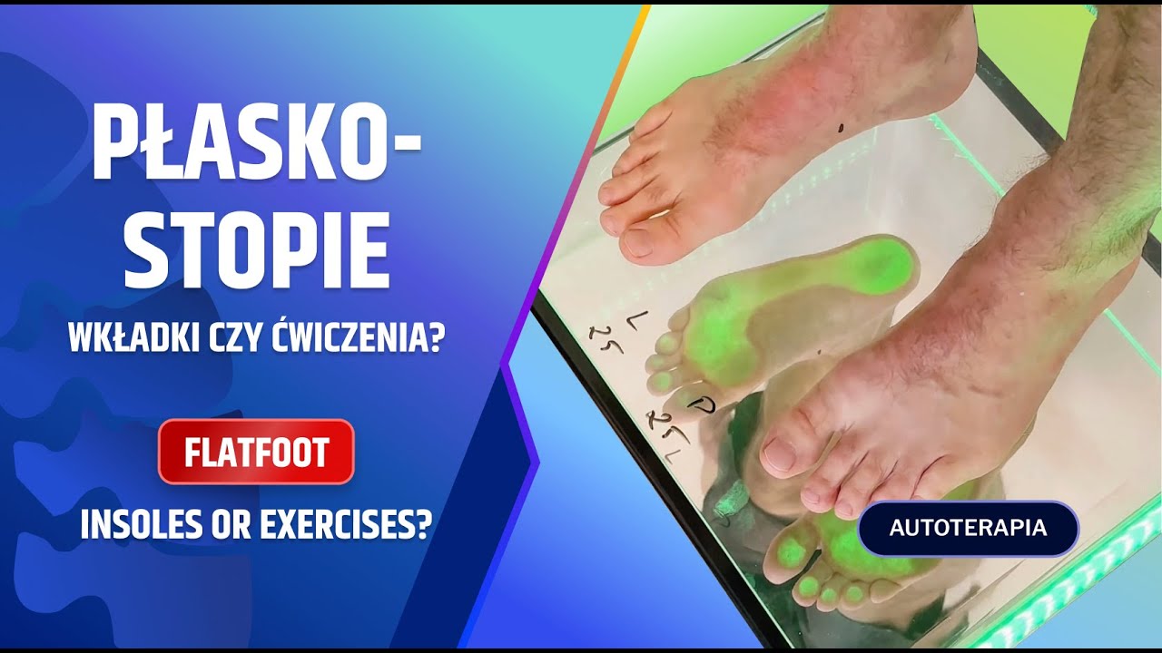 MASZ PŁASKOSTOPIE? Wkładki czy ćwiczenia? Podolog czy fizjoterapeuta? #3