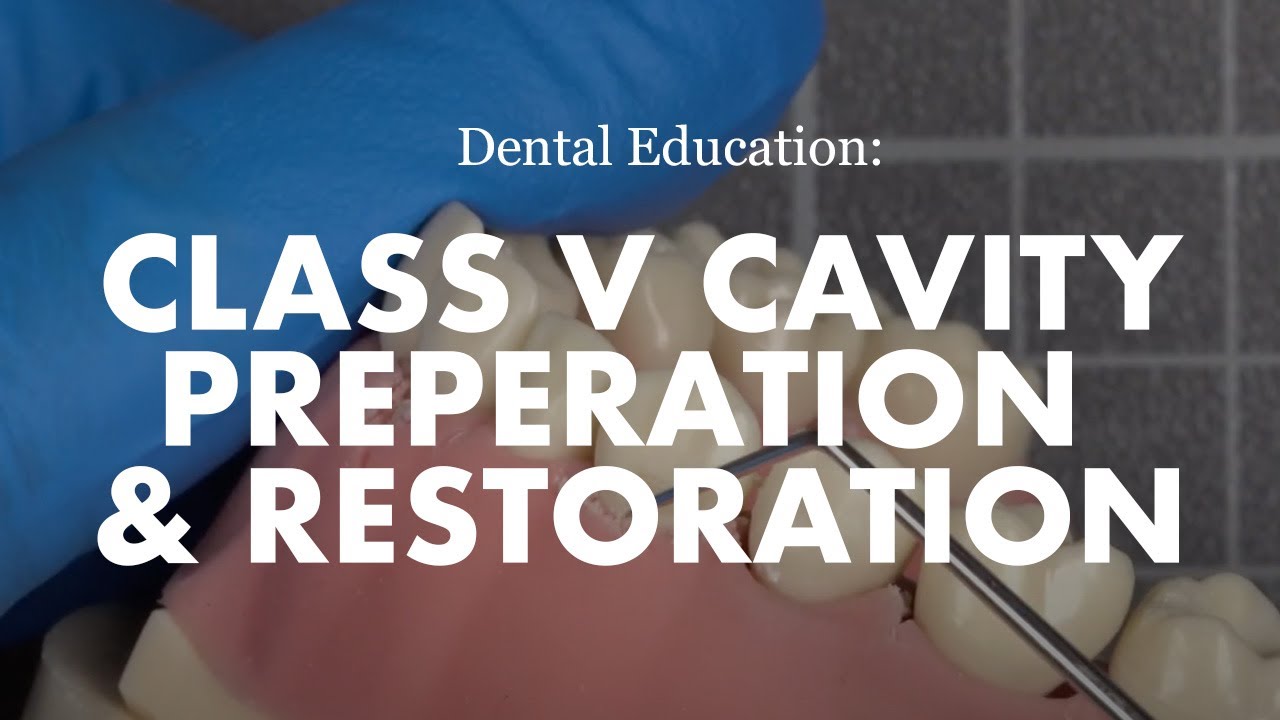 Class V cavity preparation and restoration