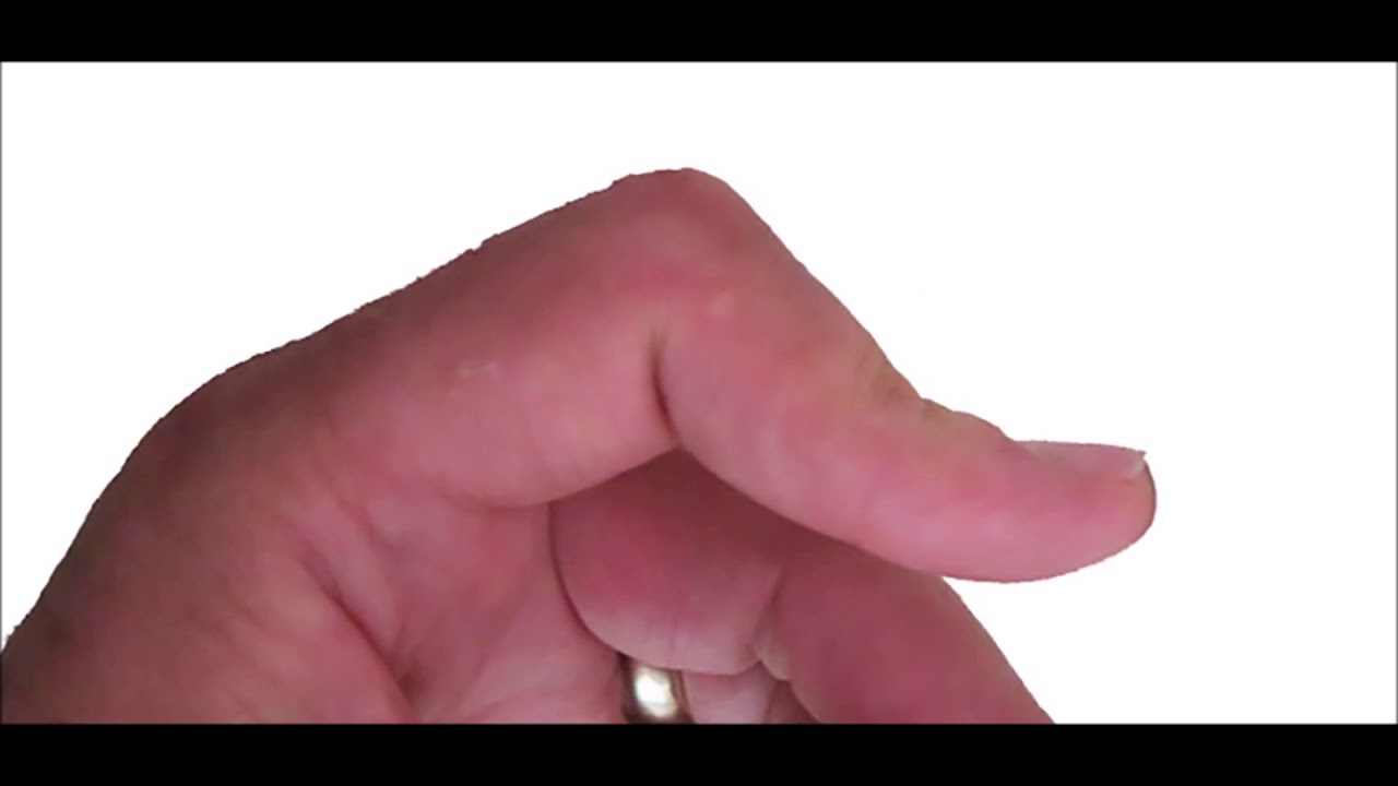 OT Rex - Avulsion Injuries - Mallet Finger, Boutonniere, Swan Neck Deformity