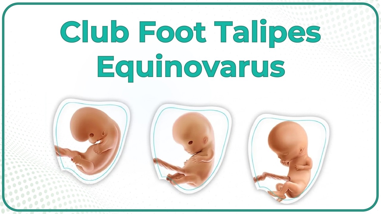 Косолапость / Talipes equinovarus: причины, симптомы, диагностика и лечение