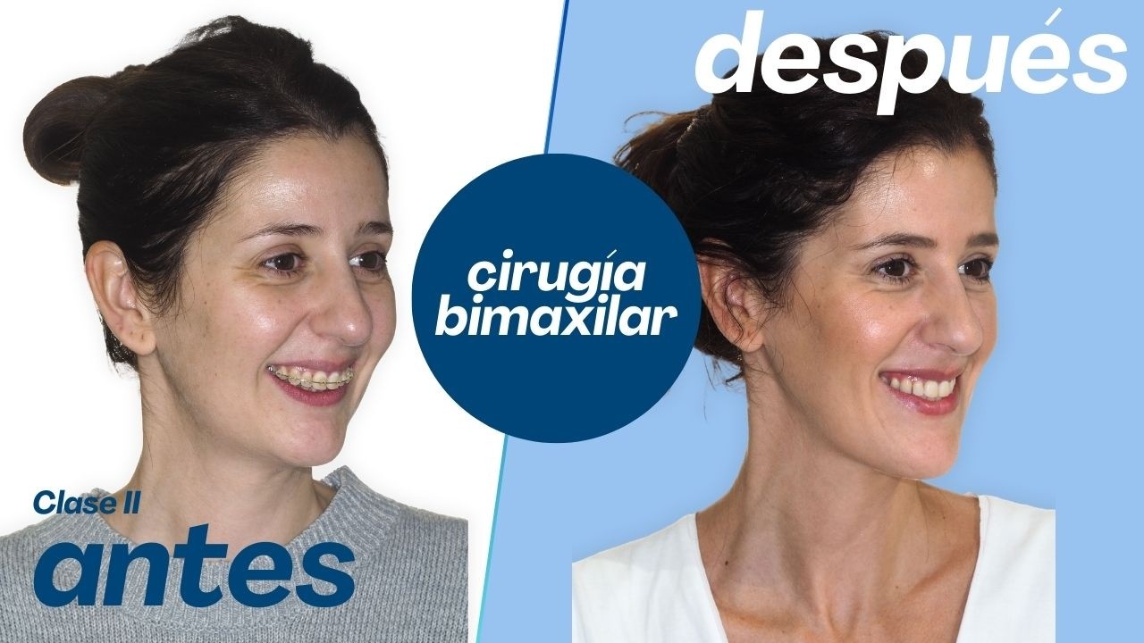 Cirugía bimaxilar Caso #180: Soraya -Clase II, Hipoplasia mandibular, Biretrusión